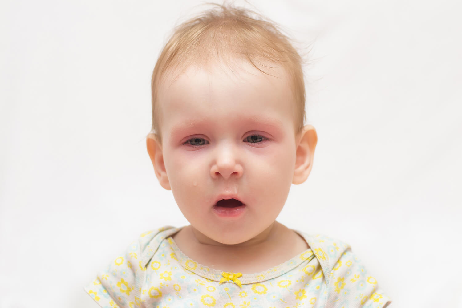 baby with red eyelid